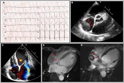 Case Report: A Mysterious Giant Thrombus in the Right Atrium in a Patient With Dilated Cardiomyopathy